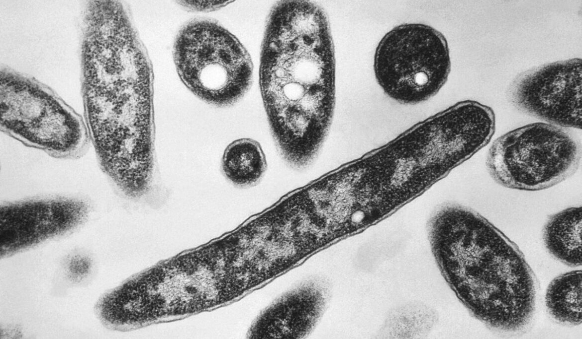 Lung transplant suspected of giving recipients Legionnaires' disease