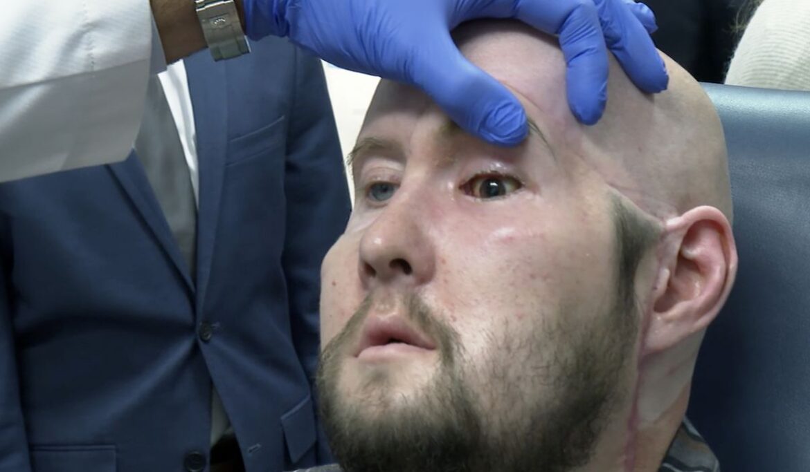 New York University surgeons perform world's first whole eye and partial face transplant