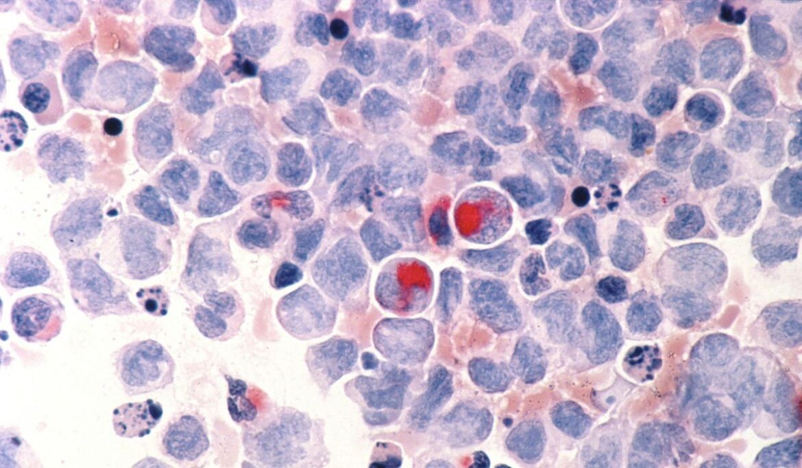 Progress in childhood cancer has stalled for Blacks and Hispanics, report says