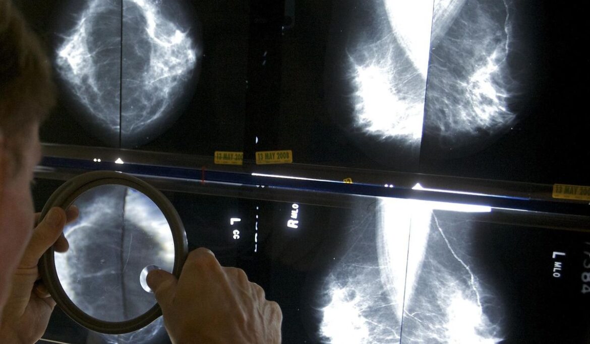 Breast cancer survivors may not need so many mammograms after surgery, U.K. study suggests