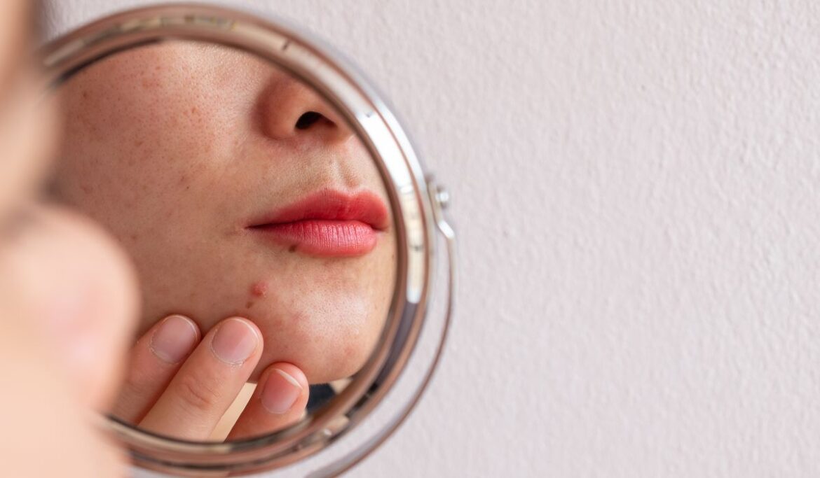 Federally funded study finds acne hurts social life, job prospects